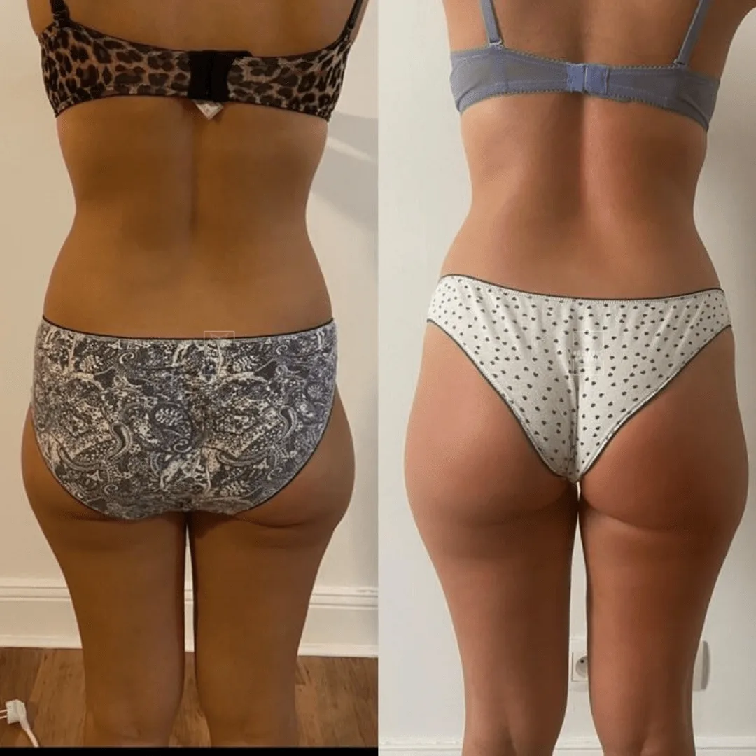 Avant / après drainage lymphatique et remodelage — dos, taille et fessiers, vue de dos