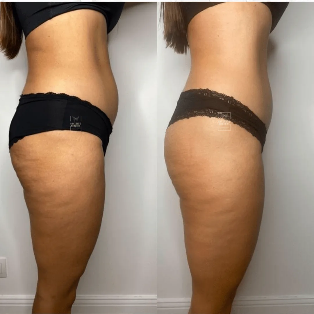 Avant / après drainage lymphatique et remodelage — fessier et cuisse, vue de profil