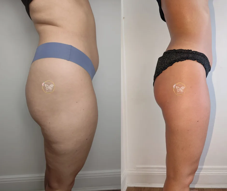 Avant / après drainage lymphatique et remodelage — fessiers et cuisses, vue de profil