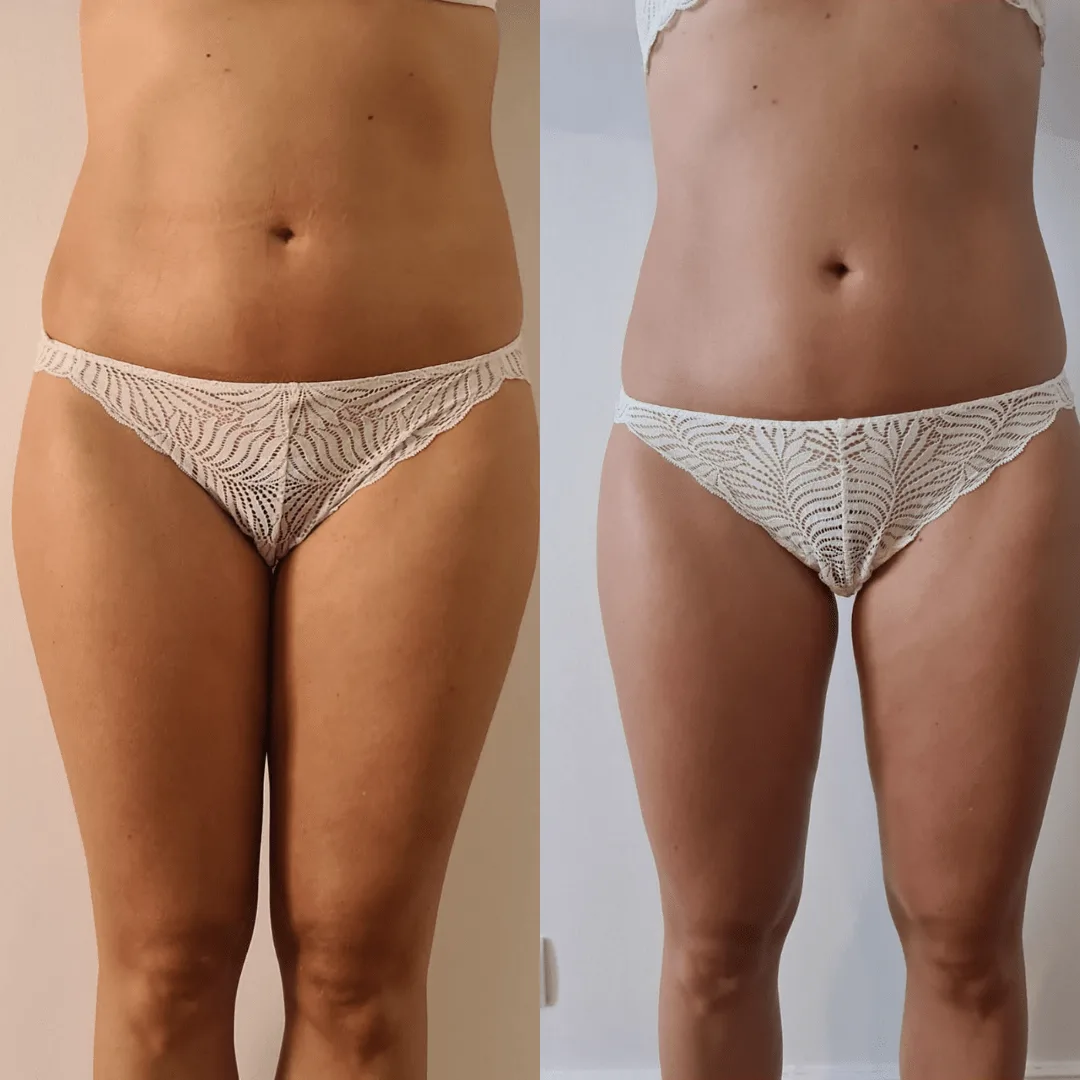 Avant / après drainage lymphatique et remodelage — ventre et cuisses, vue de face