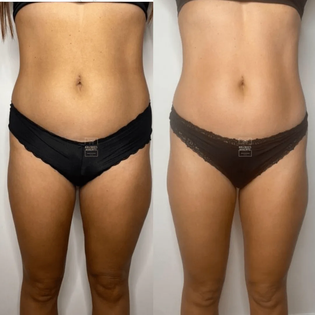 Avant / après drainage lymphatique et remodelage — ventre, vue de face