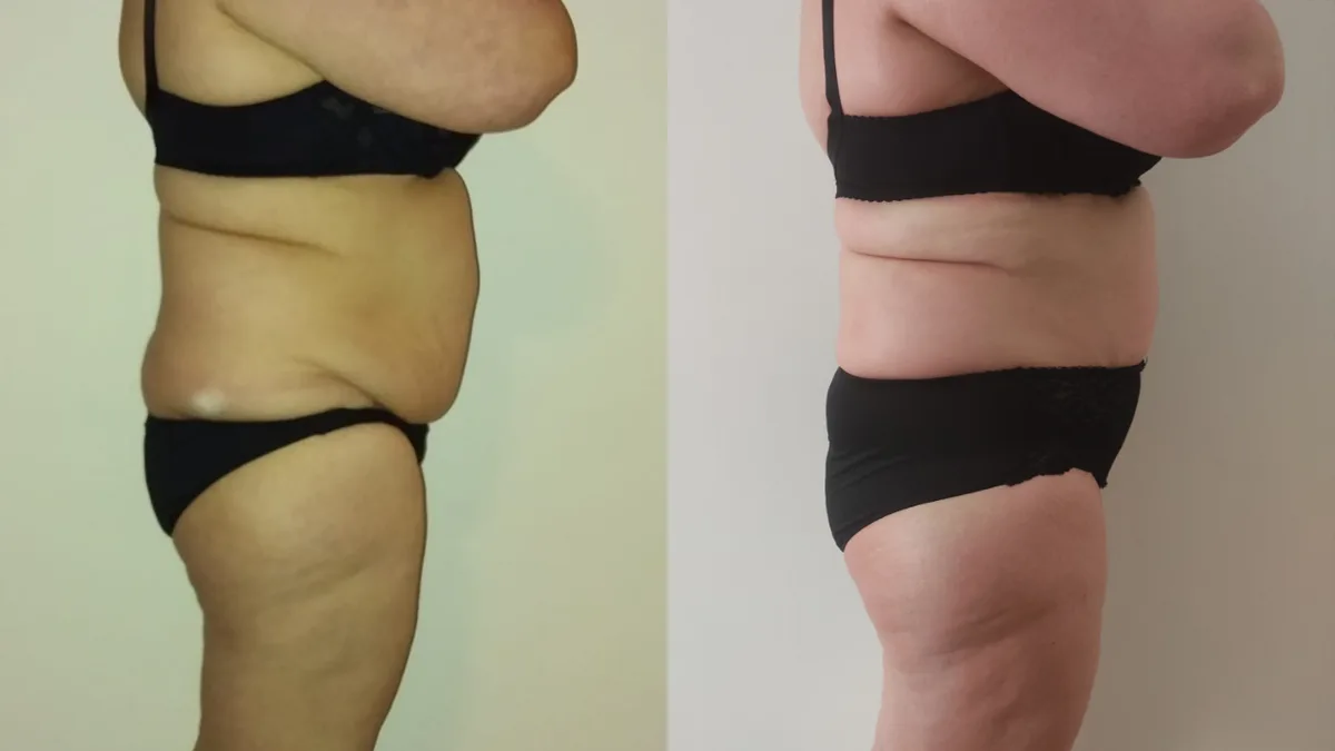 Avant / après drainage lymphatique et remodelage — ventre et flancs, vue de profil